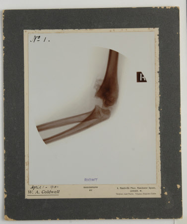 Radiograph, mounted, of Henry John Ralph Bankes (1902-1981) right elbow, goes with KLA/D/495, ref ...